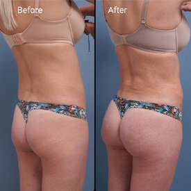 before and after Brazilian butt lift right angle view female patient Palm Beach, FL