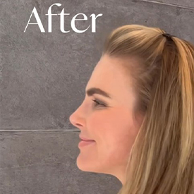 after plastic surgery left view female patient Palm Beach, Florida