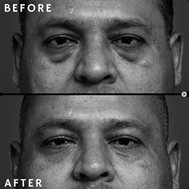 before and after plastic surgery front view male patient Palm Beach, FL