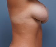 right side view female patient after breast augmentation case 814 Palm Beach, FL