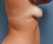 right side view female patient before breast augmentation case 814 Palm Beach, FL