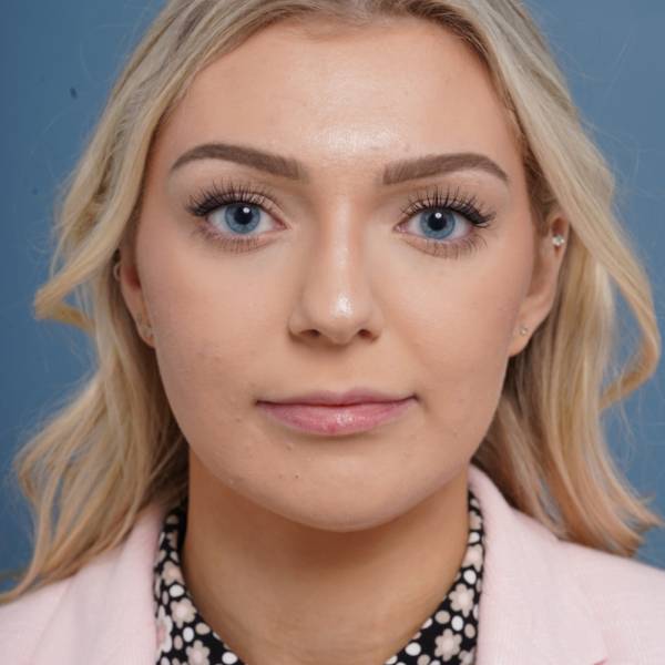 before rhinoplasty front view female patient case 798