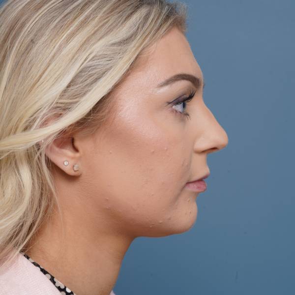 before rhinoplasty right side view female patient case 798