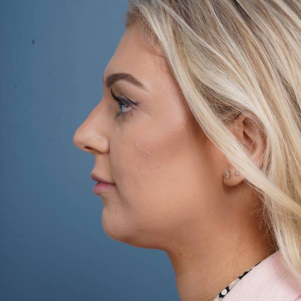 before rhinoplasty left side view female patient case 798