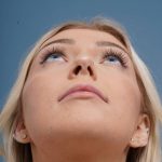 before rhinoplasty front head up view female patient case 798