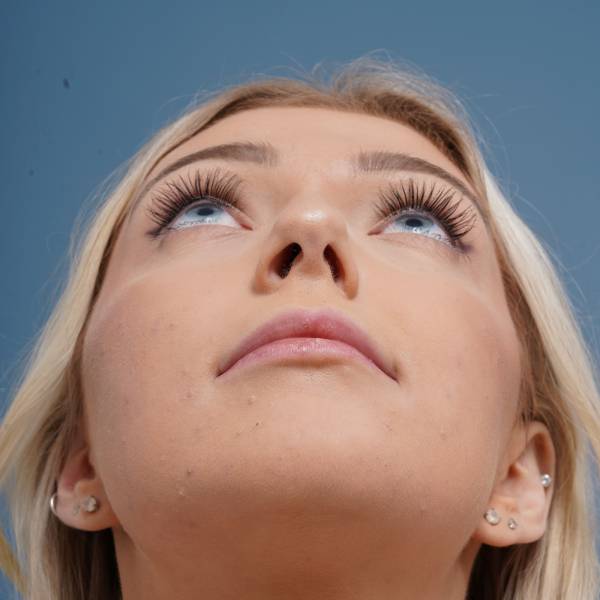 before rhinoplasty front head up view female patient case 798