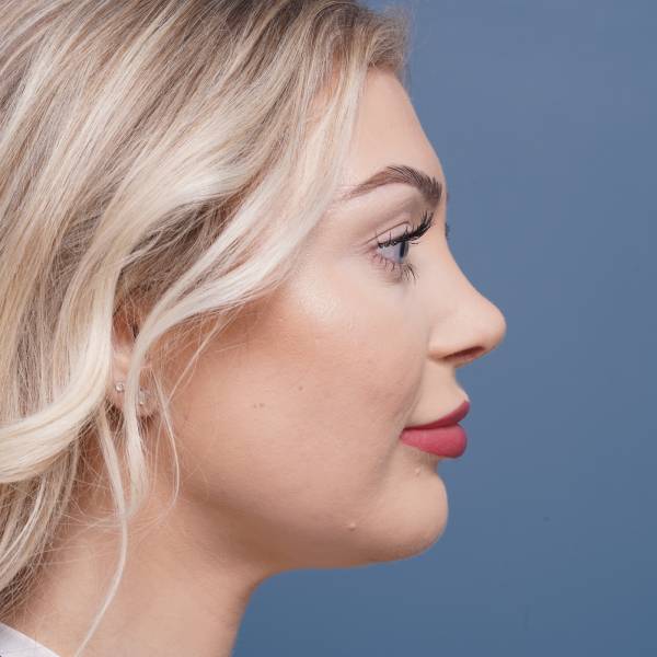 after rhinoplasty right side view female patient case 798