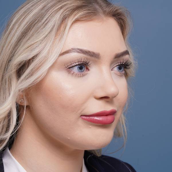 after rhinoplasty right angle view female patient case 798