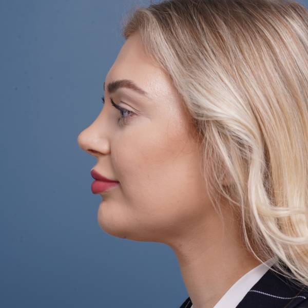 after rhinoplasty left side view female patient case 798