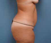 Before left side view Tummy Tuck Case 784 female patient Palm Beach, FL