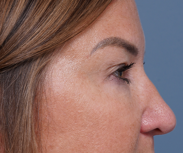 before brow lift right side closeup view female patient case 1560