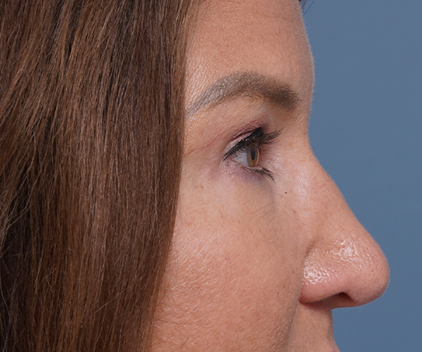 after brow lift right side closeup view female patient case 1560