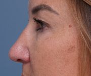 before brow lift left side closeup view female patient case 1560