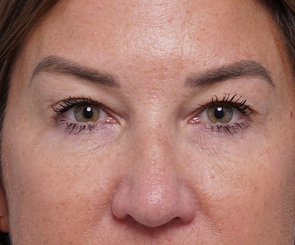 before brow lift front closeup view female patient case 1560