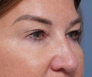 before brow lift right angle closeup view female patient case 1560