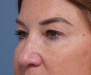 before brow lift left angle closeup view female patient case 1560