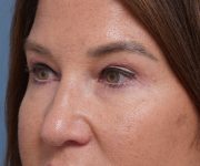 after brow lift left angle closeup view female patient case 1560