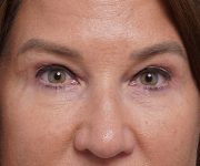 after brow lift front closeup view female patient case 1560