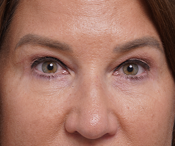 after brow lift front closeup view female patient case 1560