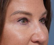 after brow lift right angle closeup view female patient case 1560