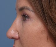 after brow lift left side closeup view female patient case 1560