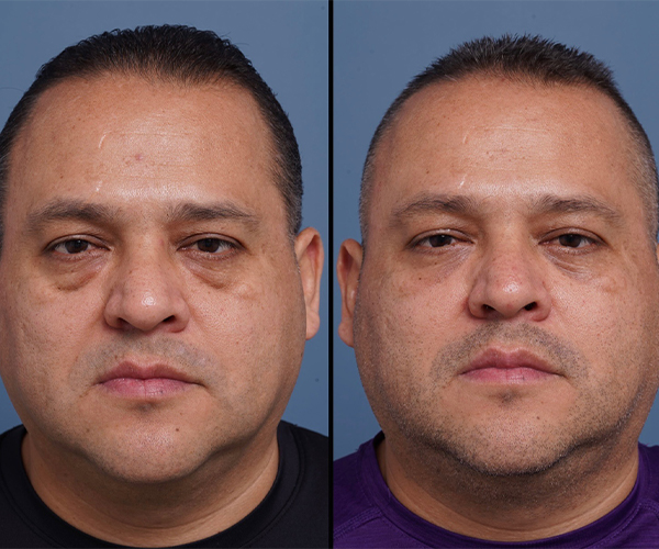 before and after blepharoplasty brow lift front view male patient case 1571
