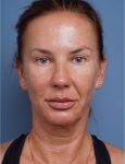 before facelift neck lift front view female patient case 1582