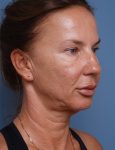 before facelift neck lift right angle view female patient case 1582