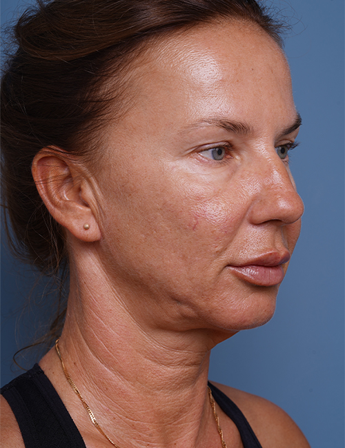 before facelift neck lift right angle view female patient case 1582