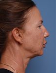 before facelift neck lift right side view female patient case 1582