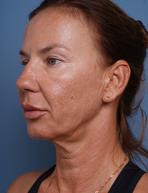 before facelift neck lift left angle view female patient case 1582