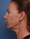 before facelift neck lift left side view female patient case 1582