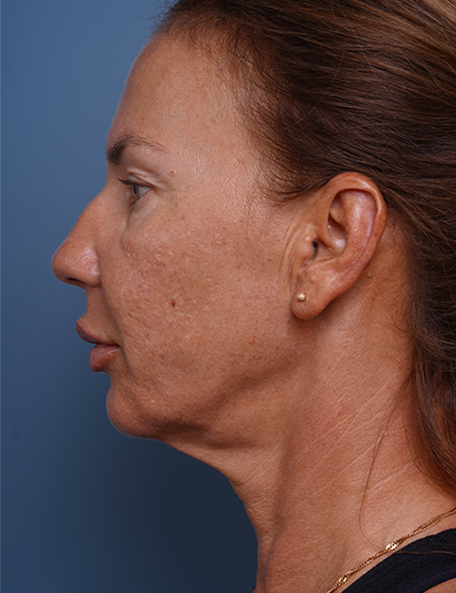 before facelift neck lift left side view female patient case 1582
