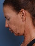 before facelift neck lift left side face down view female patient case 1582