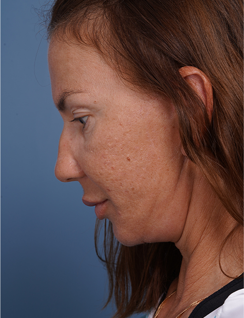 after facelift neck lift left side face down view female patient case 1582