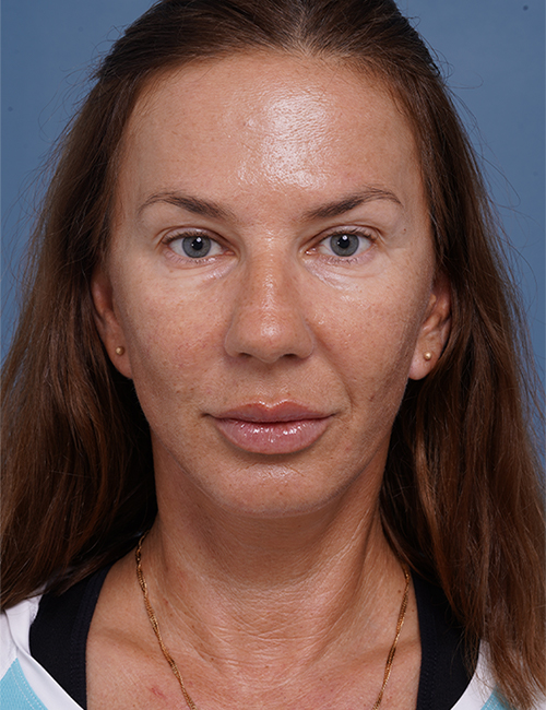 after facelift neck lift front view female patient case 1582