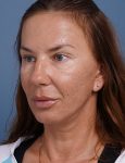 after facelift neck lift left angle view female patient case 1582
