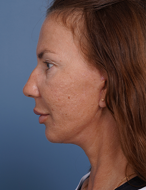 after facelift neck lift left side view female patient case 1582