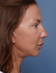 after facelift neck lift right side view female patient case 1582