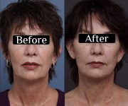 before and after facelift neck lift front view female patient case 1597