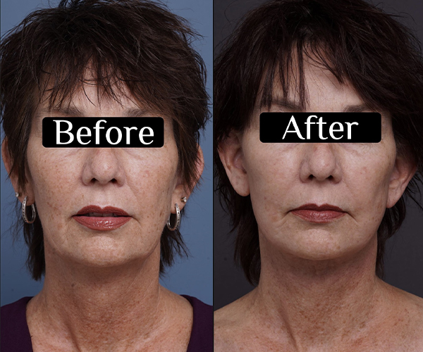 before and after facelift neck lift front view female patient case 1597