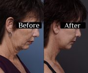 before and after facelift neck lift right side face down view female patient case 1597