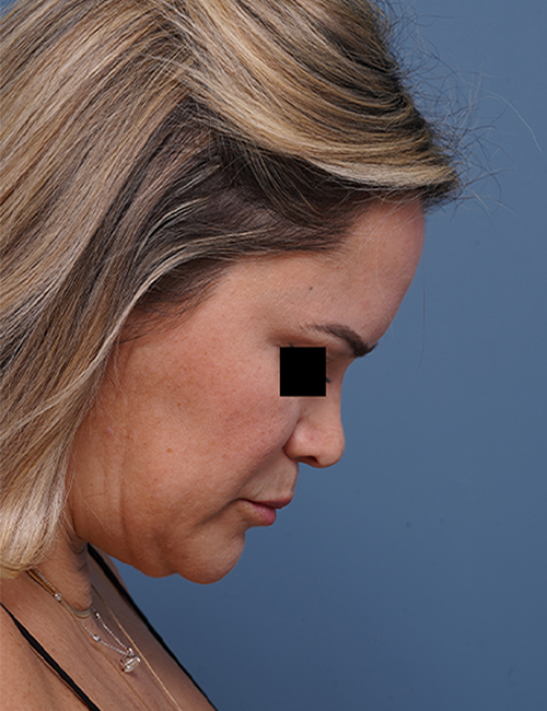 before facelift neck lift right side face down view female patient case 1573