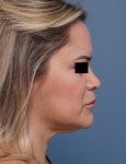 before facelift neck lift right side view female patient case 1573