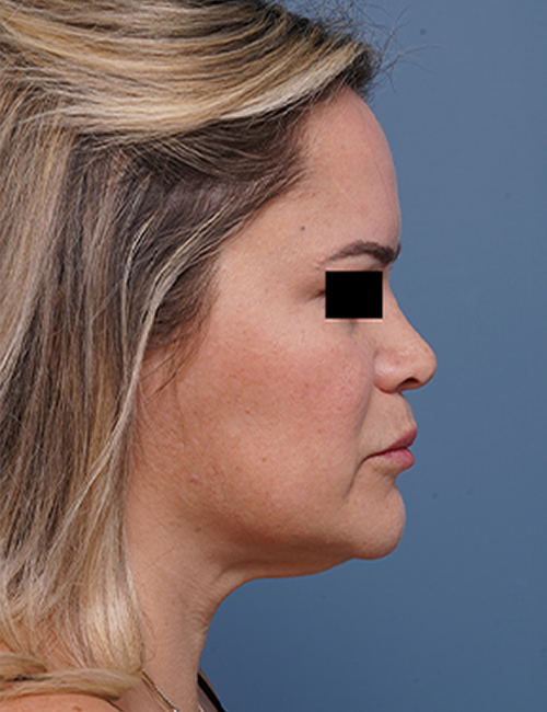 before facelift neck lift right side view female patient case 1573