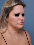 before facelift neck lift right angle view female patient case 1573