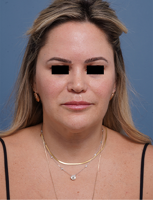 before facelift neck lift front view female patient case 1573