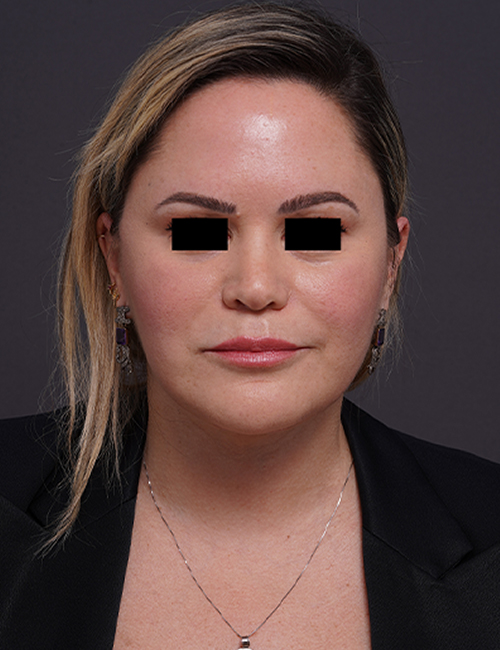 after facelift neck lift front view female patient case 1573