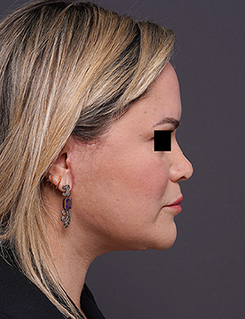after facelift neck lift right side view female patient case 1573