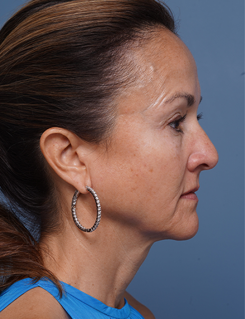 before facelift neck lift right side view female patient case 1602